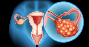 Cáncer de ovario 1